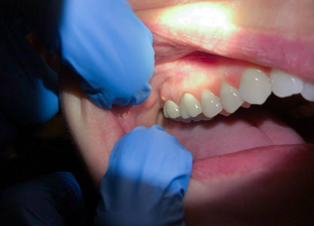 Best Emergency Tooth Extraction in St Marys, WV